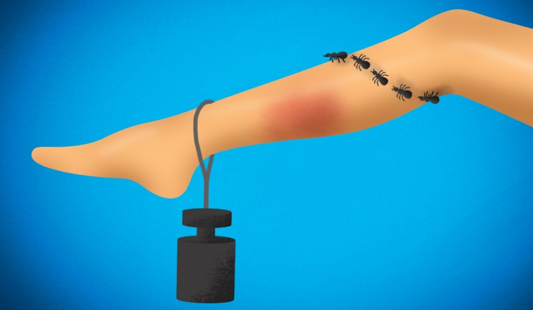 Heavy leg with varicose veins and reddening
